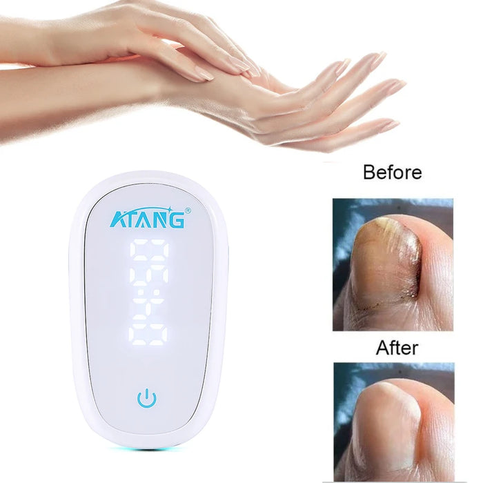 905NM Nail Fungus Laser Therapy Device Mini Painless Nail Fungus Cleaning Device Portable Anti-Slip Silicone for Foot Care Tools