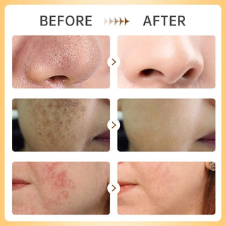 Tea Tree Face Skin Care Set Mask Acne Treatment Serum VC Whitening Turmeric Spots Cream Deep Cleaning Clay Mud Facial Mask 200g